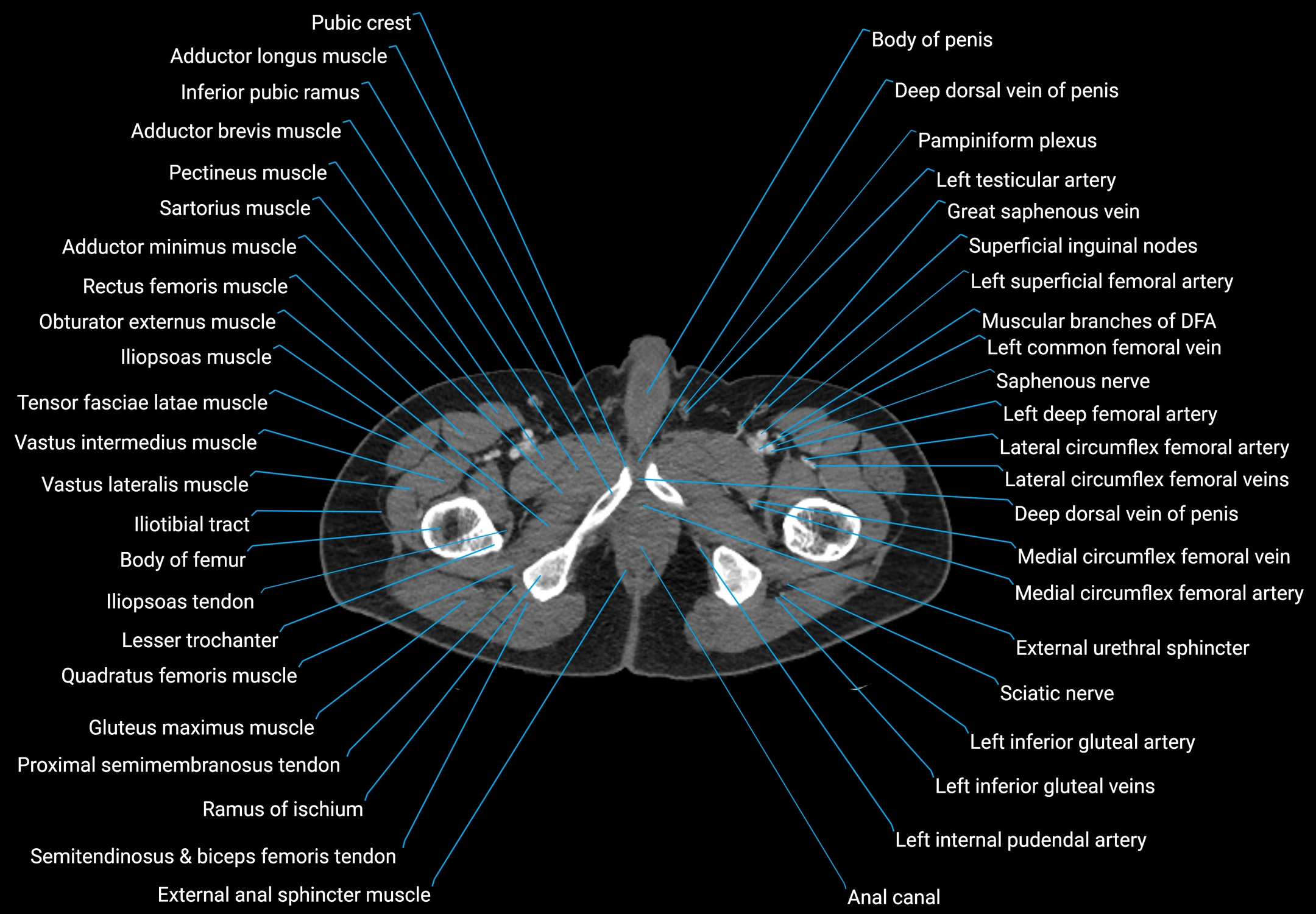 CT male pelvis axial cross sectional anatomy labelled radiology image -00210.webp